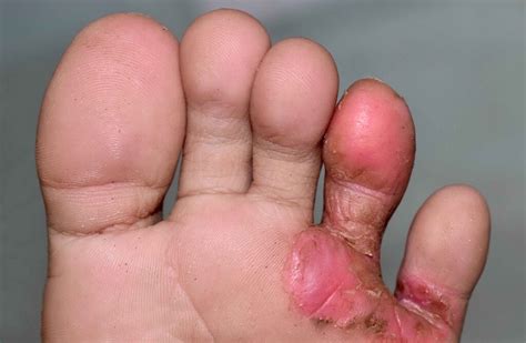 Tinea Pedis Unveiled A Comprehensive Guide To Signs Symptoms Causes