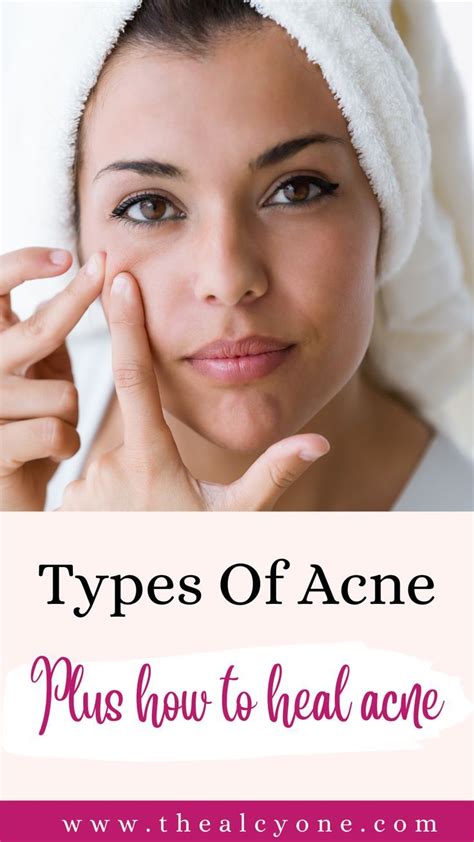 Top 10 Common Cause Of Acne And Treatments Artofit