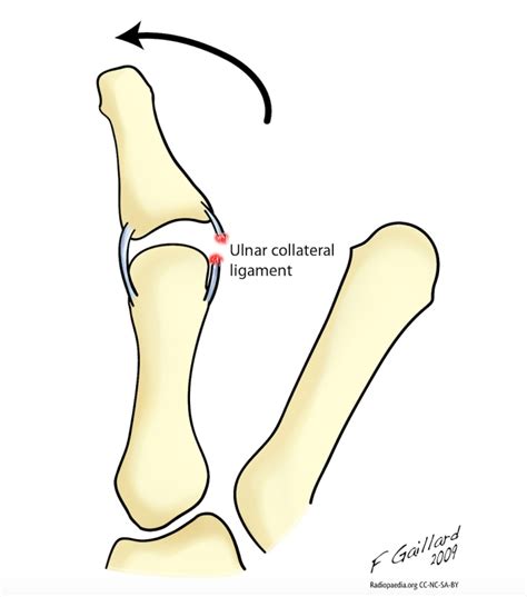 Ulnar collateral ligament (UCL) injury of thumb – The Lothian Hand Unit