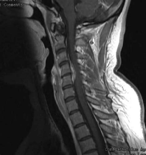 T1 Weighted Sagittal Magnetic Resonance Imaging With Contrast Of The