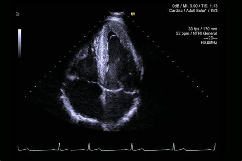 Herzultraschall Was Sie über Die Echokardiographie Wissen Sollten