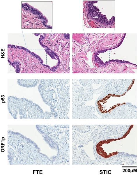 Line 1 Orf1p Is Expressed In Incidental Stic Lesions Representative