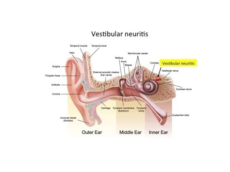 Vestibular Neuritis | Pillars of Wellness Burlington