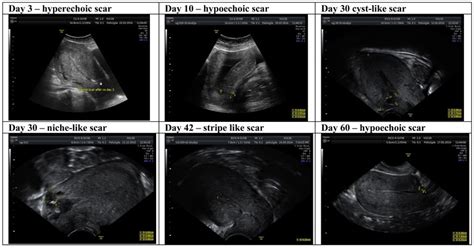 Uterine scar view changes. | Download Scientific Diagram