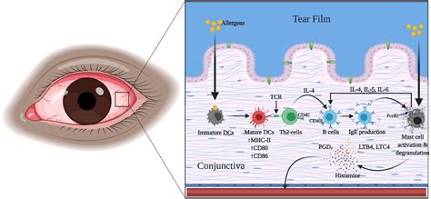 Bulbar Conjunctival Hyperemia