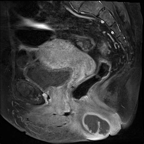 Perinephric Abscess Ultrasound