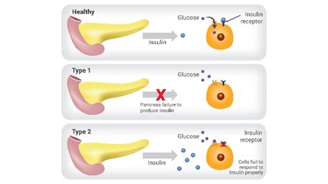 Type 1 Diabetes Mellitus T1dm