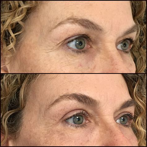 Upper Blepharoplasty Gone Wrong