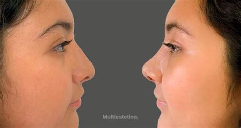 La Rinoplastia Ultrasónica Tiene Más Ventajas Que Una Rinoplastia