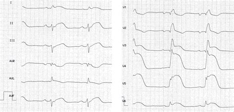 Myocarditis Ecg Cureus Acute Myocarditis Presenting As Acute Coronary