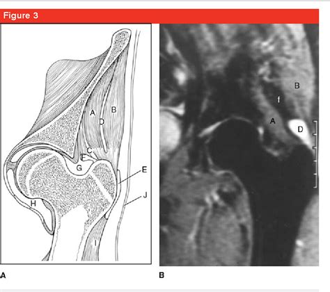 Figure 3 From Abductor Tendon Tears Of The Hip Evaluation And Management Semantic Scholar