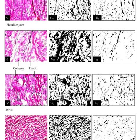 Verhoeff Van Gieson Staining Appearance Of Collagen Pink Colour And