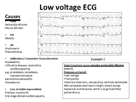 Low Voltage Ecg The Qrs Is Said To