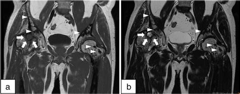 Coronal MRI of Both Hips. A subchondral cyst within the right femoral ...