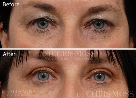 Eyelid Surgery Blepharoplasty Melbourne By Dr Chris Moss