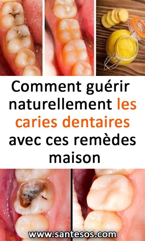 Comment Gu Rir Naturellement Les Caries Dentaires Avec Ces Rem Des