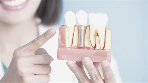 Diferencia entre implantes y puentes dentales Clínica Dental PCM