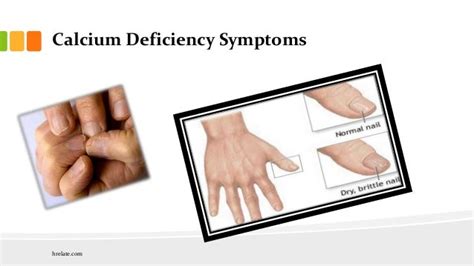 Calcium Deficiency Symptoms: Iski Kami ko Pehchane