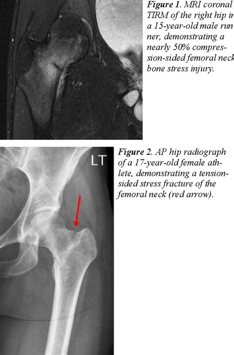 Femoral Neck Bone Stress Injuries In Pediatrics And Adolescents