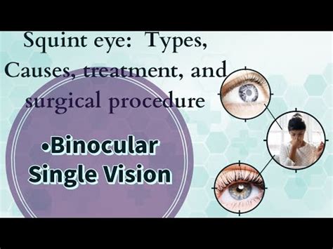 Binocular Single Vision BSV Squint Lecture 3 Grades Of BSV