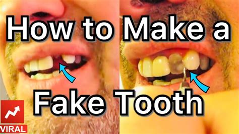 How To Fix A Veneer Tooth At Home Tarihokuludergisiblog