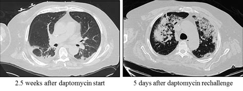 A Rare Complication Of Daptomycin Treatment For Disseminated Mssa