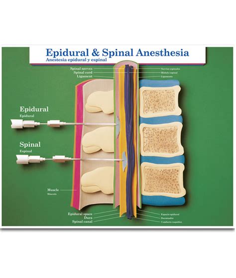 Epidural and Spinal Anesthesia Chart | Birth International