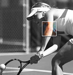 Elbow Surgery for Tennis Elbow Due Pain, Inflammation, Overuse