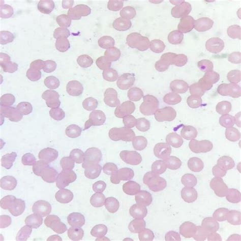 Peripheral blood smear showing presence of hypolobulated neutrophils... | Download Scientific ...