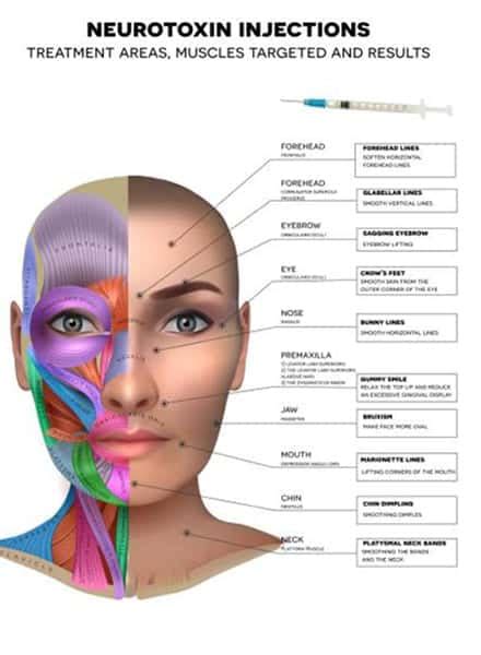 Indications Du Botox Chirurgie œil Et Paupière Paris