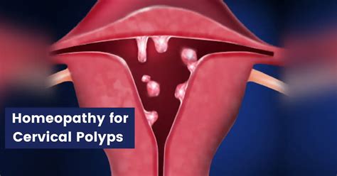 Vaginal Polyps Causes