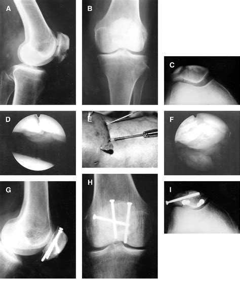 Figure 1 From Arthroscopic Assisted Percutaneous Screw Fixation Of