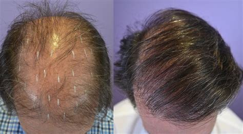 Hair Transplant On 64 Year Old Male With Diffuse Hair Loss Hair