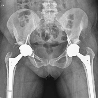 Plain Hip X Ray Of The Patient After Bilateral Hip Arthroplasty