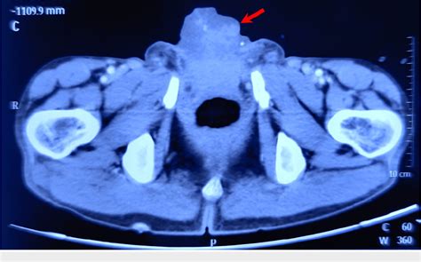 Figure 1 From A Rare Case Of Urinary Bladder Exstrophy Presenting With