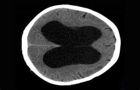 Idiopathic Normal Pressure Hydrocephalus The Bmj