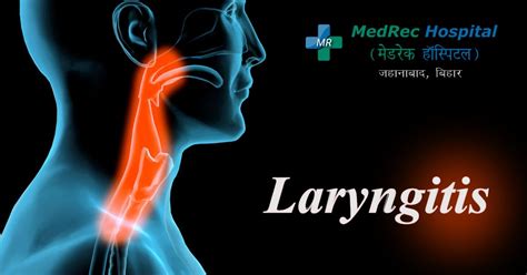 Laryngitis Prevention Symptoms And Treatment Options