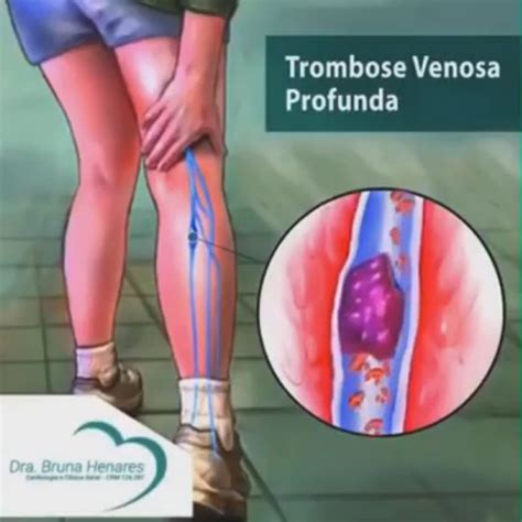 Trombose Venosa Profunda Dra Bruna Henares