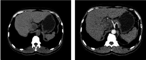 CT scan showed a large lesion arise from the caudate lobe (Case 3 ...