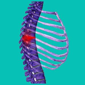 Thoracic Spine Bulging Disc Symptoms