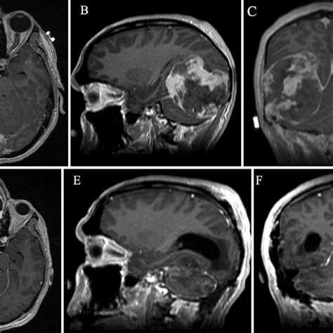 Preoperative Sagittal A And Axial B T1 Weighted Gadoliniumenhanced Download Scientific