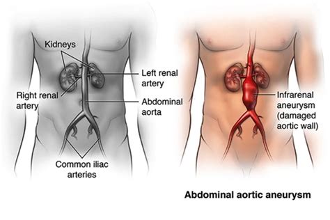 Abdominal Aortic Aneuysm Sfvvg