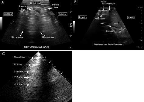 Lung Ultrasound The Essentials Radiology Cardiothoracic Imaging