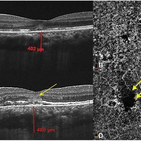 Comparison Of Horizontal B Scans Of Spectral Domain Optical Coherence