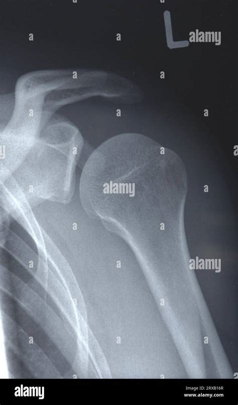 Shoulder joint, X-ray Stock Photo - Alamy