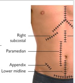 Surg Exam 2 Lecture 1 Surgical Incisions 5 Qs Flashcards Quizlet