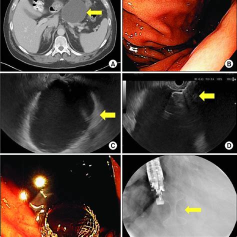 Hypoechoic mass in the body of the pancreas (B-mode ultrasound). | Download Scientific Diagram