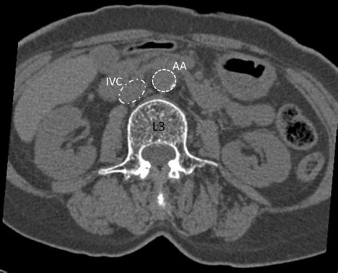 Iatrogenic Arteriovenous Fistula And Retroperitoneal Hemorrh Jbjs