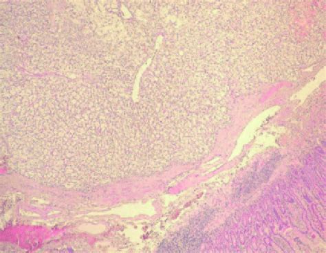 Tinción Hematoxilina Eosina X100 Neoformación De Células Claras Que