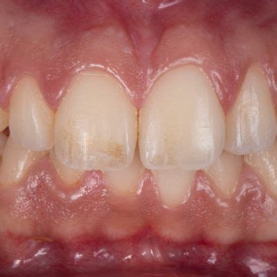 Casos Clínicos Clínica Ariaga A sua Clínica Dentária na Madeira